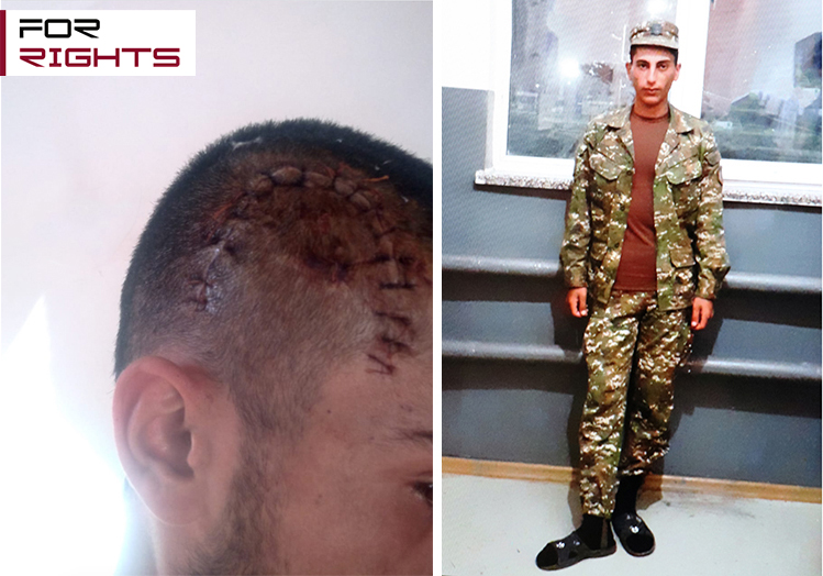 Ծանր վիրավորում ստացած զինվորին հաշմանսամության 3-րդ կարգ են տվել. «Երրորդ բեկորը գտնվում է տղայիս հենց գլխուղեղի մեջ»